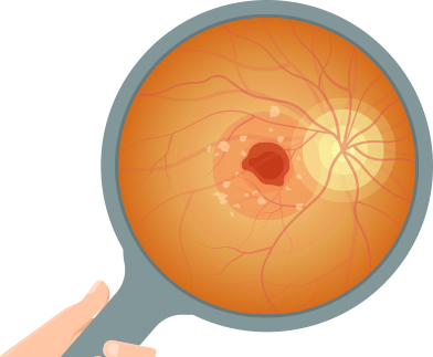 希瑪眼科中心_老年黃斑病變